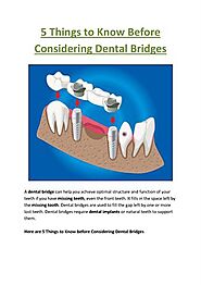 5 Things to Know Before Considering Dental Bridges