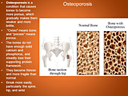 NAD, Osteoporosis, Senescent Cells, And Stem Cells: The Final Frontier In Osteoporosis