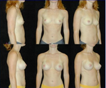 breast surgeries in newport