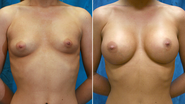 breast surgery