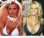 Get breast implants today