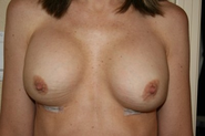 Breast implants for your boobs