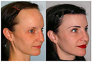 Female Hair Loss Treatment | Hair Restoration For Women