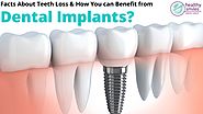 How You can Benefit from Dental Implants?