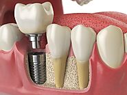 How Long Does the Dental Implant Process Take at Blackburn dentist in Melbourne?