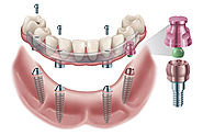 Dental Implants in PA