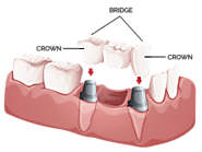 Dental Crowns – The Basics – American Dental Designs