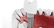 Dental Implant Surgery Can Be Done For Single Tooth Or Many Teeth