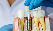 Dental Implant Surgery is Essential For Replacing Natural Teeth