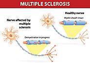 Website at https://www.drvanchilingamhospital.com/multiple-sclerosis