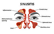 TMJ Diseases Treatment Kerala, Sinusitis Treatment Delhi, India