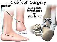 Treatment for Clubfoot