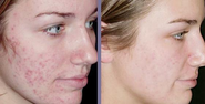 Revitol Scar Cream