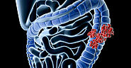 Balanced Diet and Regular Exercise Curtails Colon Cancer | Insights Care