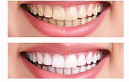 Tooth Whitening – BEDC