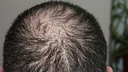 Hair loss: Why does it happen, and can it be stopped? - Health - ABC News
