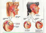TMJ Disorder Treatment - ETOMS
