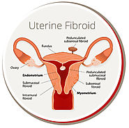 Non Surgical Uterine Fibroids Treatment | USA Vascular Centers