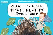 Sandeep Bhasin's answer to What is a hair transplant? - Quora