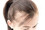 How to easily make your Hair Transplantation painless?