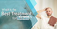 Which is the Best Treatment for Baldness?