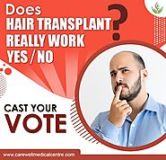 Does hair transplant really work? Yes/No