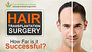 Hair Transplantation Surgery: How Far is it Successful? | Blog Care Well Medical Centre