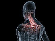 Cervical Sprain from Car Accident
