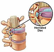 Pinched Nerve & Herniated Disc from Car Accident