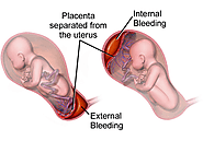 Placenta Problems in Pregnancy – Makkar Multispeciality Hospital