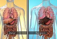 This Is Why Liver Transplant is a Life Saving Surgery