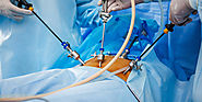 Laparoscopic Surgery Vs Open Surgery - Things You Need to Know