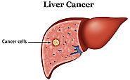 Here’s Knowing the Signs And Symptoms of Liver Cancer
