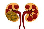Know about the best three ways of treat your kidney stone