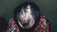 The most common causes of hair loss among women - The Clinical Advisor