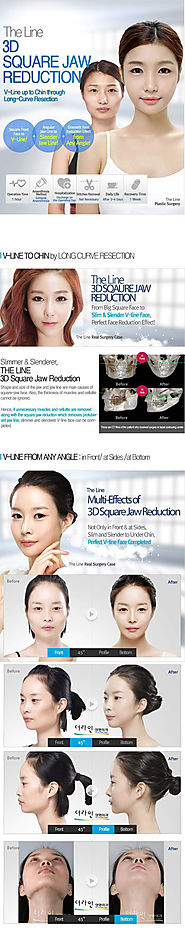 Mandibular Jaw Surgery, 3D Square Jaw Surgery in Korea - The Line Clinic