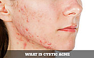 What is Cystic Acne
