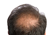 10 things you should know about male hair loss - Men's Health