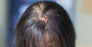 Six common causes of hair loss in men and women