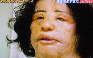Cosmetic surgery addict injected cooking oil into her own face