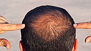 Will PRP Stop My Hair Loss?