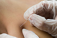 Website at https://onetherapy.com/techniques/trigger-point-dry-needling/