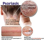 Psoriasis troubles you? Consult or... - Dr. Geeta Gera Skin, Hair & Laser Clinic | Facebook