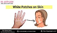 White patches on your skin is... - Dr. Geeta Gera Skin, Hair & Laser Clinic | Facebook