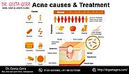 Acne Causes & Treatments. Get rid of... - Dr. Geeta Gera Skin, Hair & Laser Clinic | Facebook