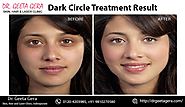 Humiliated of Dark Circles, Get rid of... - Dr. Geeta Gera Skin, Hair & Laser Clinic | Facebook