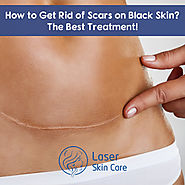 How to Get Rid of Scars on Black Skin? - Scar Removal Treatment