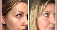 Acne Scar Treatment Reviews - Doctor Approved Treatments That Work Dubai - Dubai Laser Treatment