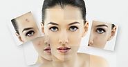 Acne Treatment in Your Own City Hamilton | NewAgeLaser