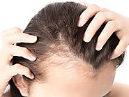 Female pattern baldness: Causes, treatment, and prevention